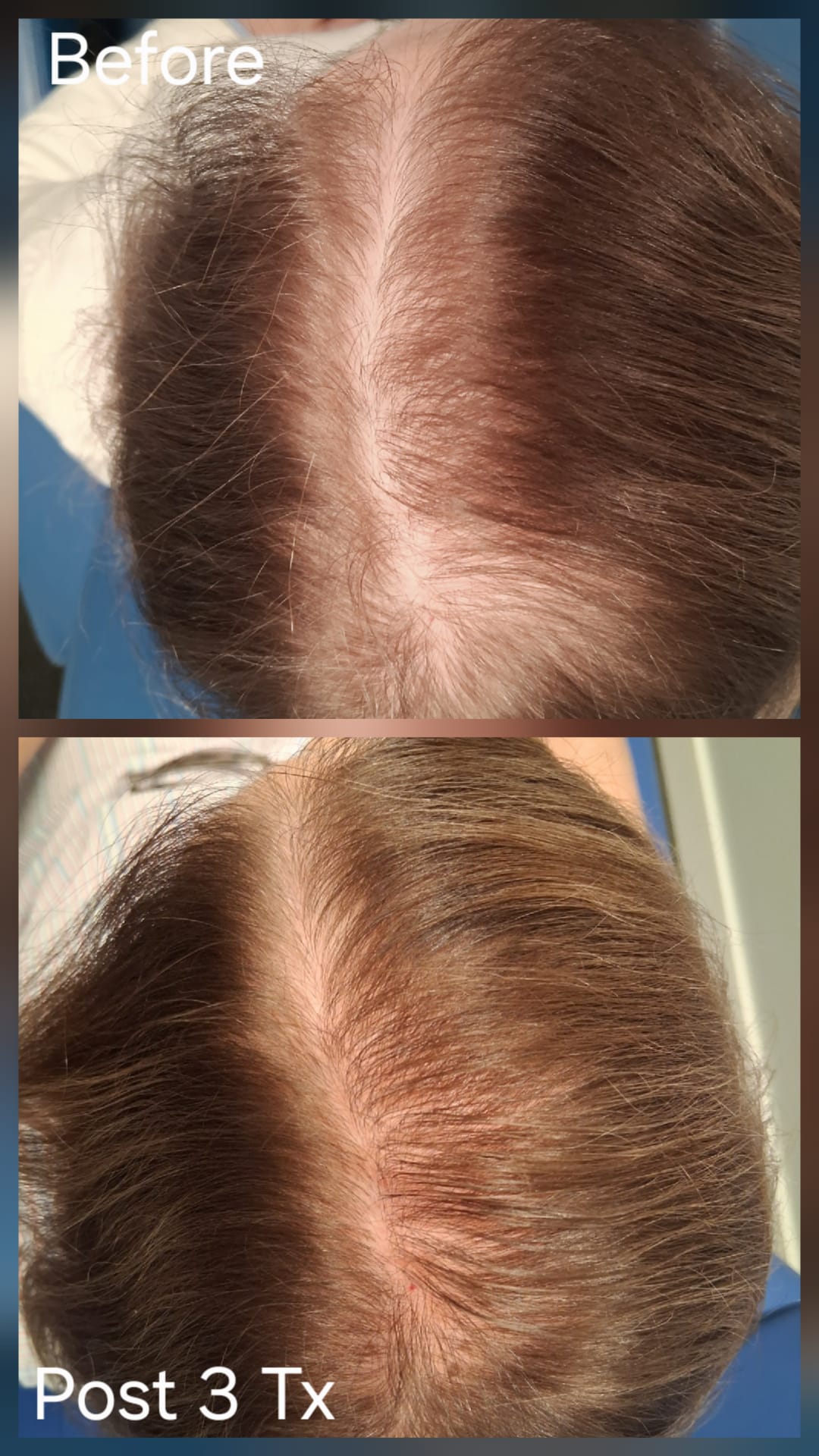 Hair restoration result